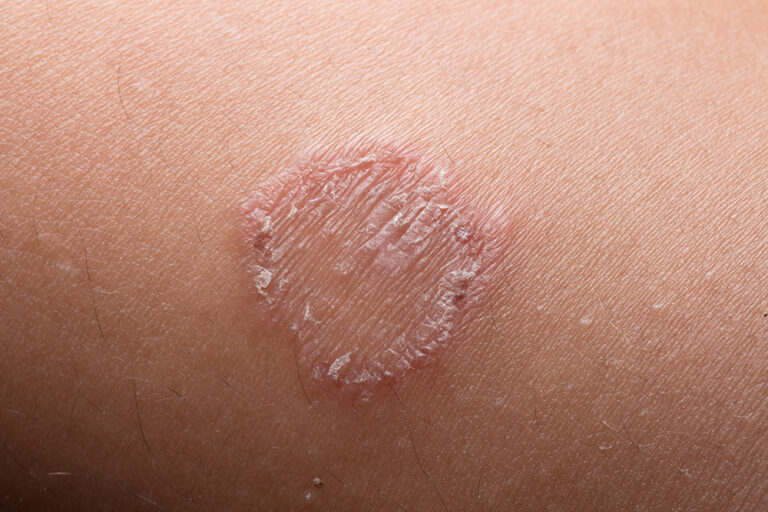 【医師監修】ぜにたむしを市販薬で治療する | ドクターズチョイス健康情報集