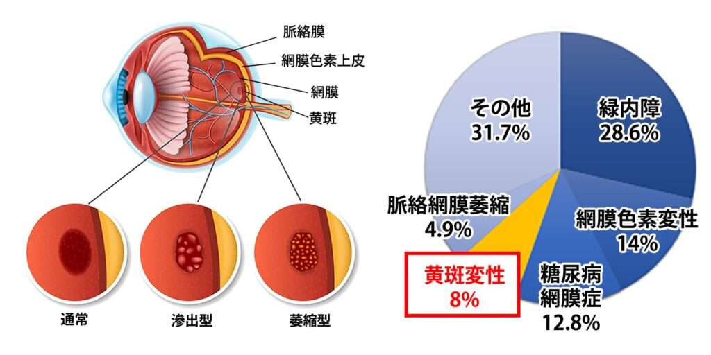 加齢黄斑変性の種類とグラフ