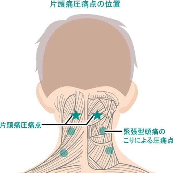 頭痛の対策時に知っておきたい「圧痛点」