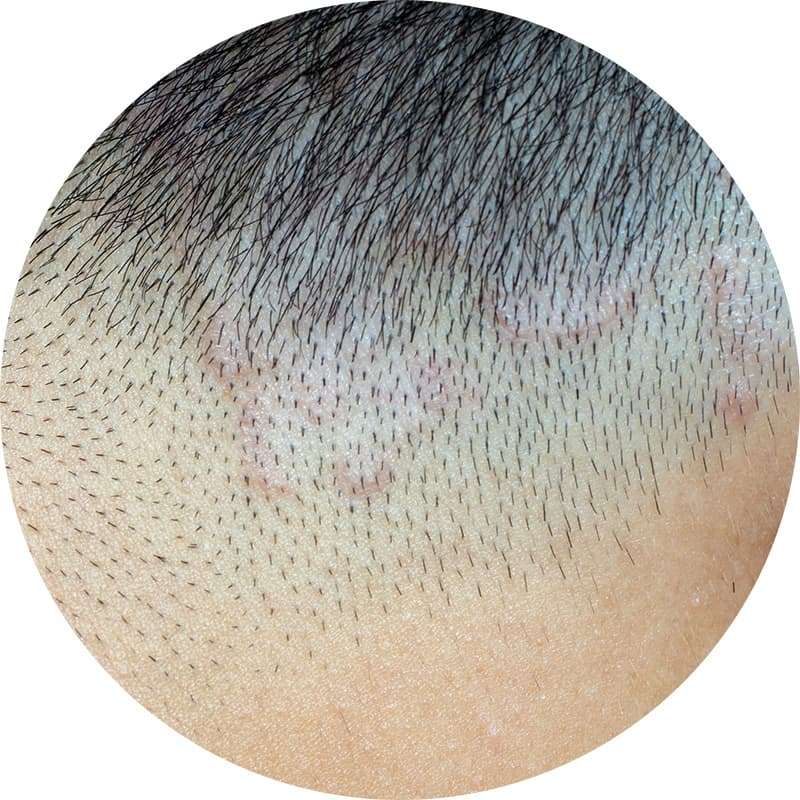頭部白癬