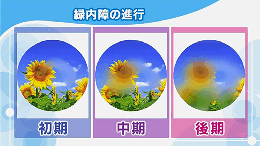 緑内障の見え方