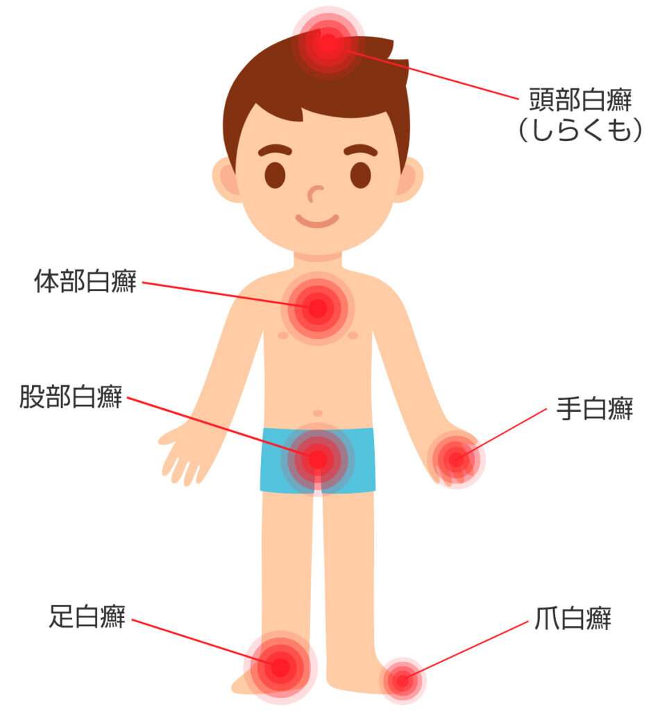 しらくも発症部位