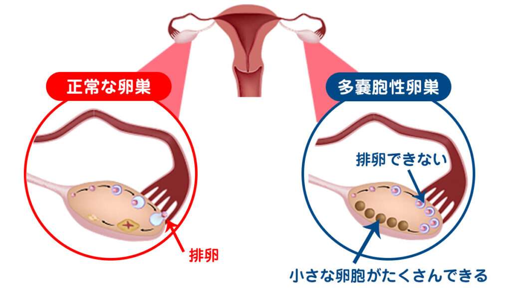 多嚢胞性卵巣症候群
