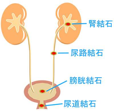 尿管結石