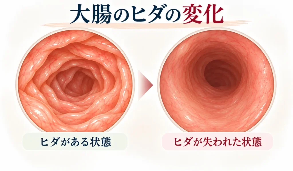 大腸のヒダの変化